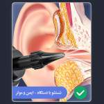 گوش پاک‌کن برقی مدل  Remover